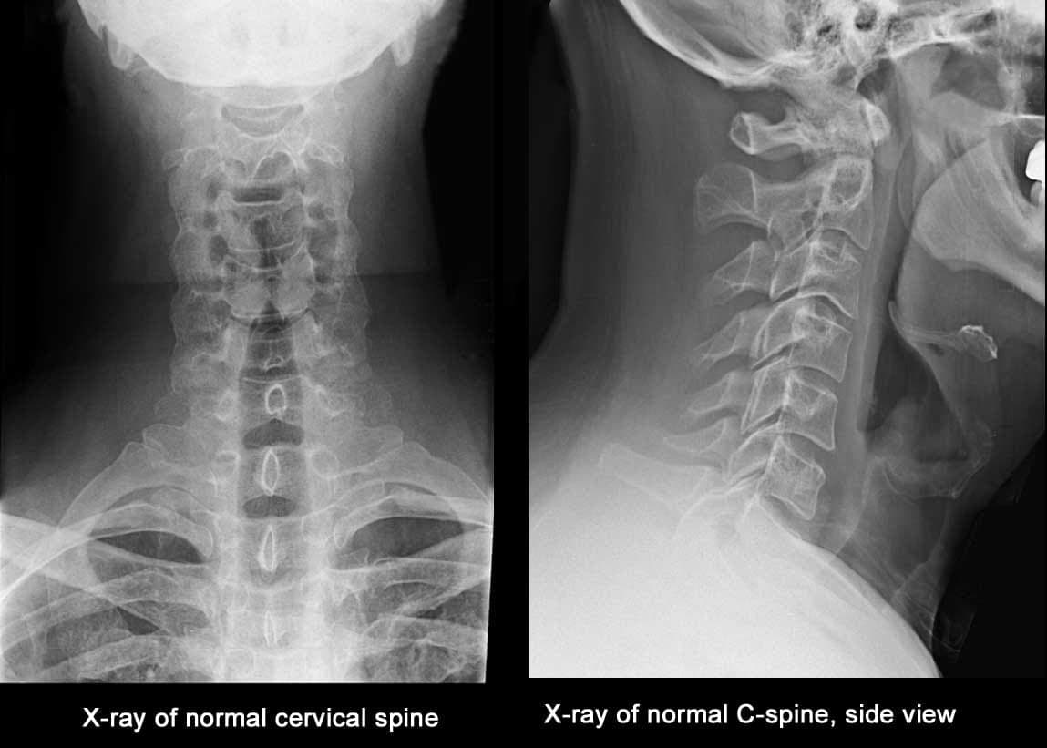 Spine XRay